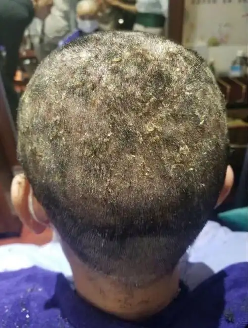 头皮屑,头皮癣 就是这么来的!