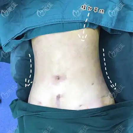 亲测郑州王俊民的腰腹吸脂修复效果凹凸不平的小肚子变的平坦了