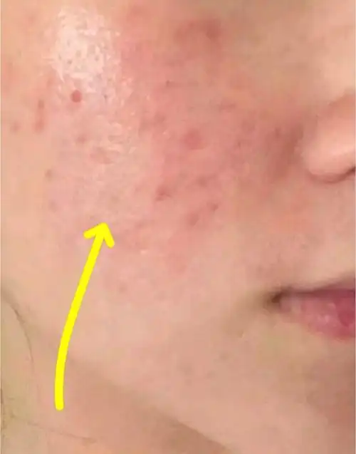 皮肤屏障受损期间裸脸15天感受总结历程在