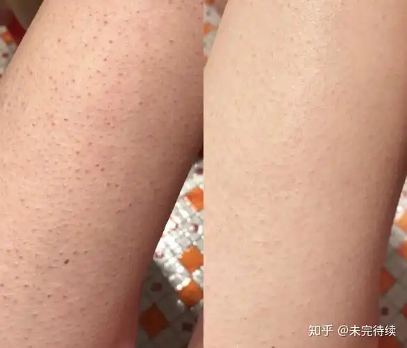 身体皮肤粗糙,肤色暗沉,怎么办? - 知乎