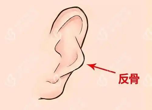 反骨耳能做手术矫正吗?耳朵反骨怎么改善方案给分享!