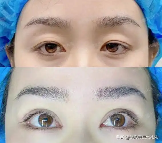 聊一聊双眼皮的款式形态都有哪些,准备做双眼皮的姐妹们来看看