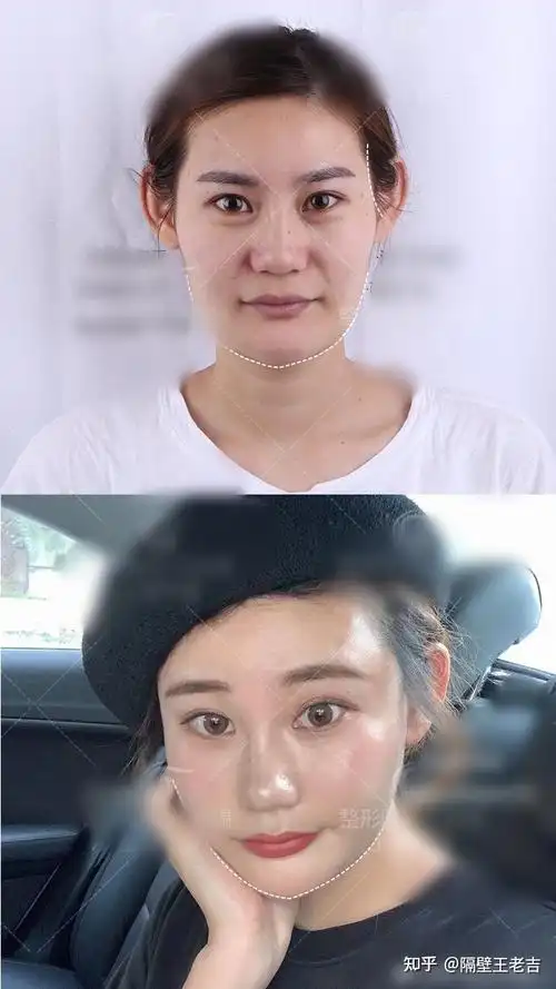 上海脂肪填充案例二