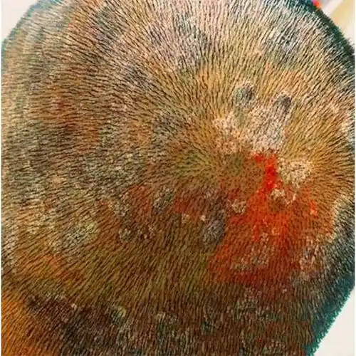 毛囊炎最好用什么洗发水