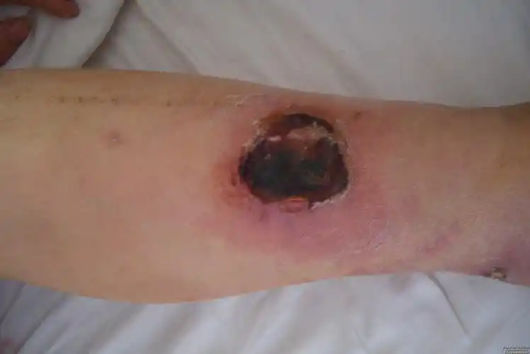 局部皮肤坏死,请指教