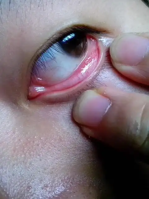 下眼睑结膜外面长了2排小滤泡,是什么东西啊,眼睛现在好不舒服