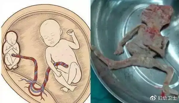 双胎胎儿-从怀孕到出生,我们都经历了什么?