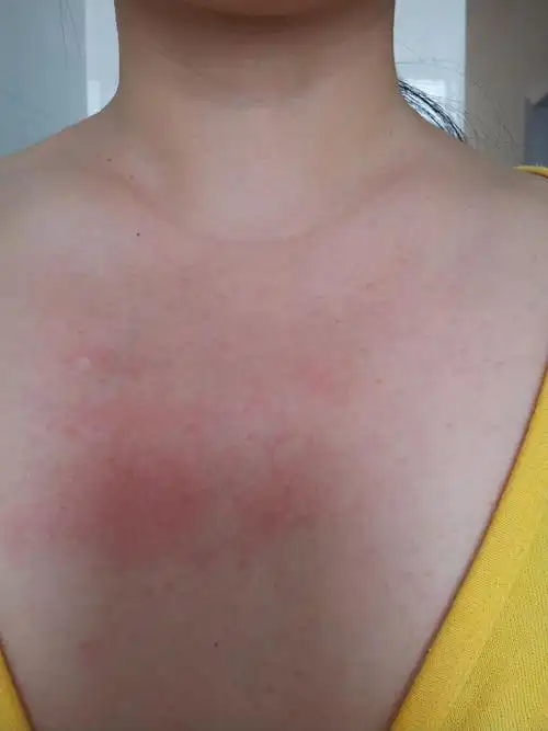 胸前长了一片小痘痘一样的点,有图