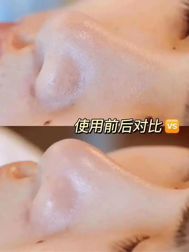 毛囊清洁一次效果对比照#逆龄抗衰 #皮肤管理 #深层毛孔清洁 - 抖音