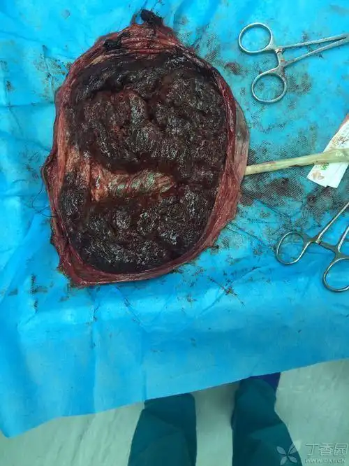 求解胎盘? [病例帖]