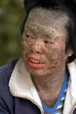 怪病男子全身长满鱼鳞 以钓鱼为生(组图)