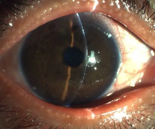 眼科经典病例干燥综合征