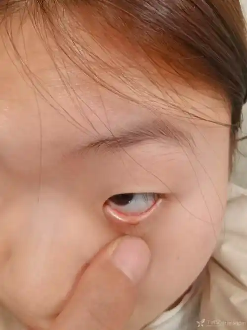 睑缘色素痣削除