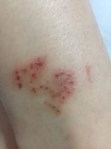 腿不知道长了什么,有时候痒,抓破了流水会烂,开始只有拇指大块,现在烂