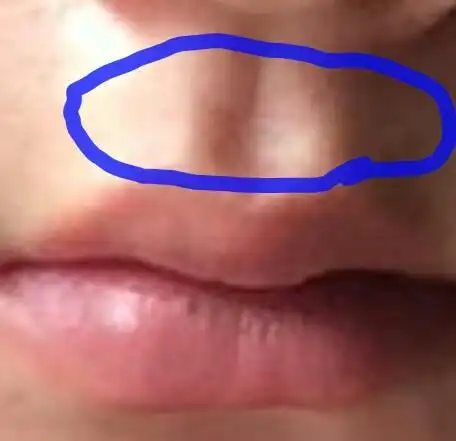 请大家仔细帮我看看,她人中那是不是一条线,还是我看错了,专业点的