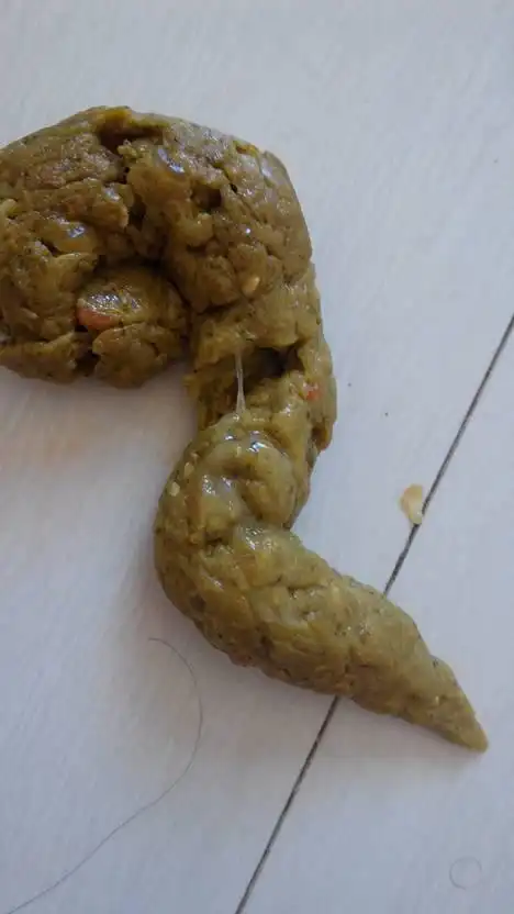 这种情况有可能是消化不良引起的  最好是检查一下大便常规和腹部彩超