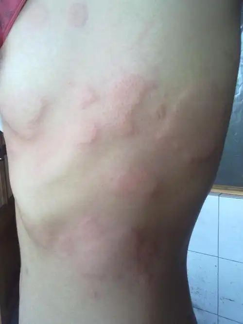 皮肤过敏的症状及相应图片