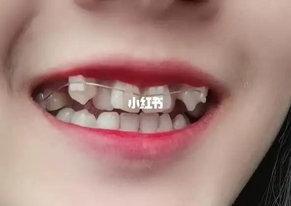 记录虎牙正畸第一个月