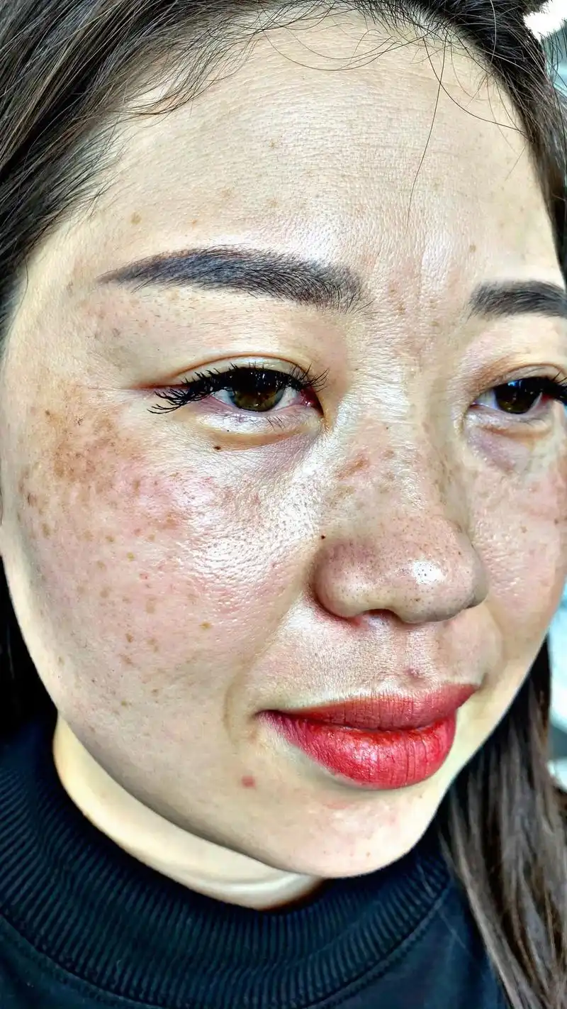 一步步看着皮肤的变化太开心了也愿意出来和朋友聚会了出来也是别人