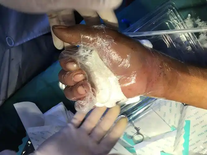 予清创 开放性指骨骨折复位 克氏针固定 肌腱缝合 vsd负压吸引