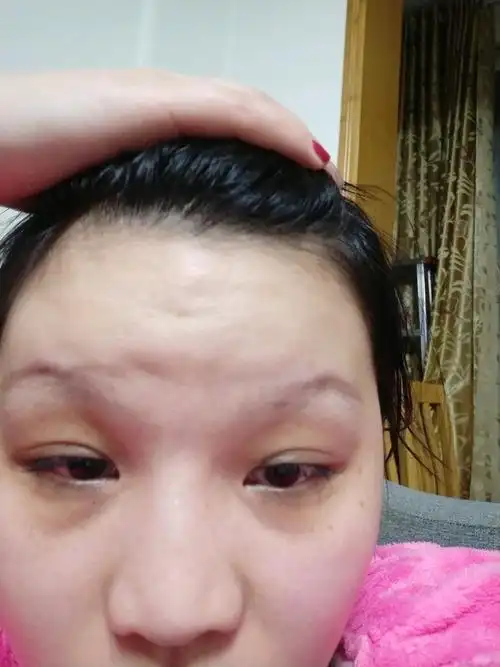 脂肪填充失败如何修复