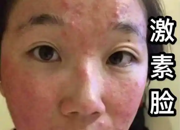 激素脸有蜕皮现象是要好了么激素脸开始脱皮是要好