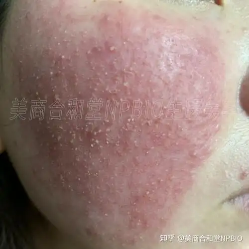 重度皮肤屏障受损合并激素性皮炎