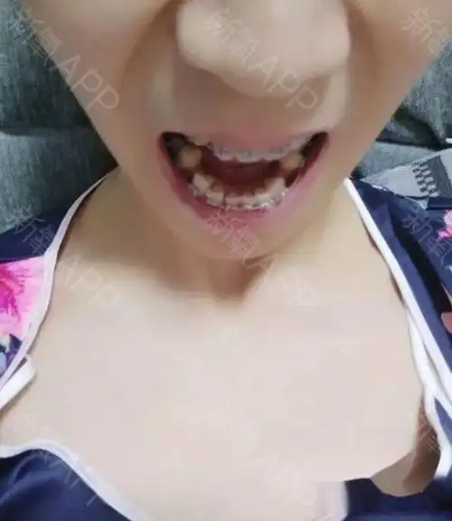 31岁大龄凸嘴虎牙突出