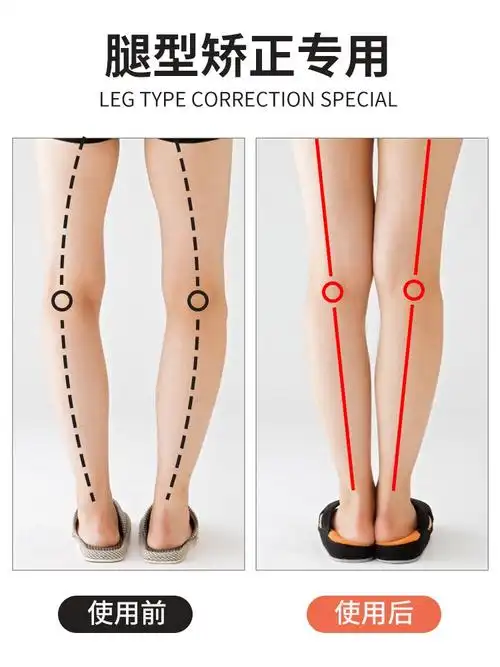 走路姿势矫正器xo型腿外八内八足弓腿形纠正磁石鞋垫成人罗圈腿.