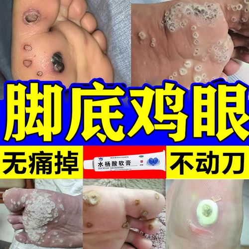 水杨酸软膏10g祛痘去黑头闭口粉刺10%-20去鸡眼去角质