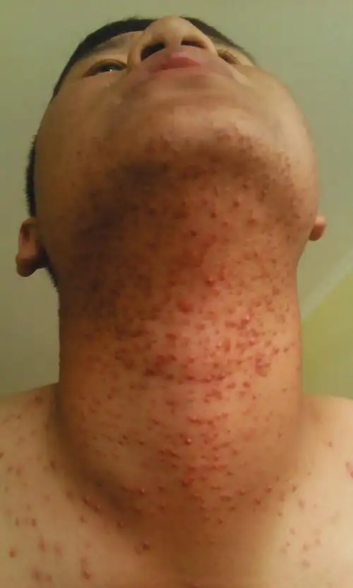 皮肤病,起初在脖子中间有一小堆,后来开始扩散,脖子有一大片了,密密