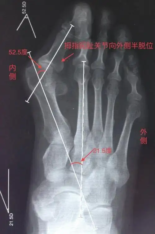 严重拇指外翻形成叠趾畸形脚拇趾外翻可分为轻度,中度及重度外翻畸形.