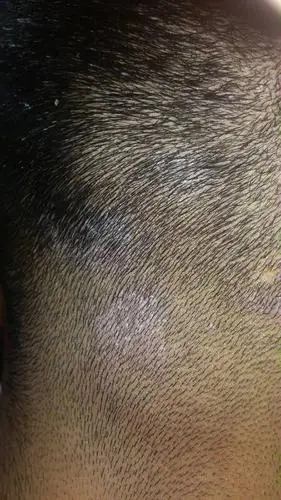 回答: 病情分析: 您好;上述的情况还是多见于真菌感染所导致的可能性