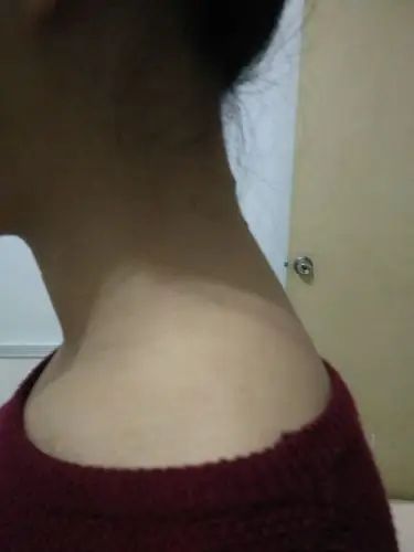 我是女生,但是后斜方肌又硬又发达,穿衣服很难看,显的脖子特别短,怎么