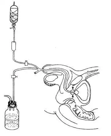 仍保留尿管者应保持尿管通畅,如有堵塞现象,可进行加压冲洗,直至通畅.