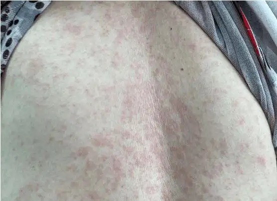 服用健康讲座上购买的保健品后长沙七旬娭毑全身长满红疹