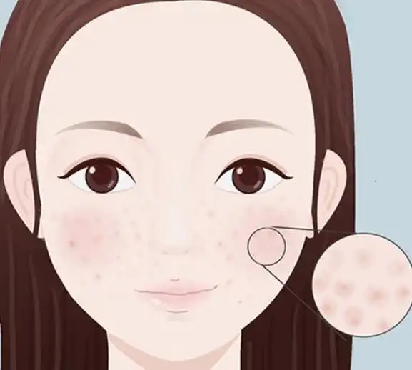 这是一篇来自蕾特恩分享关于毛孔粗大的解惑科普