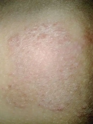 大腿内侧,皮肤病