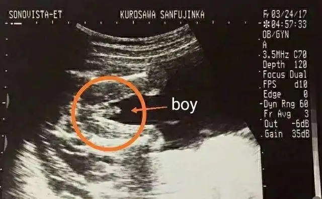 怀孕12周,男胎儿和女胎儿发育有什么差别?可能和你想的不同