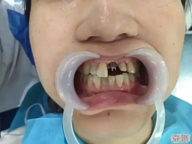 「真人案例」让你更直观的了解种植牙!