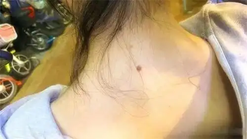 为什么很多人的脖子后面都有一颗痣?今天,我们来告诉各位答案