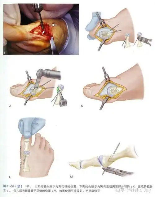 拇外翻的手术治疗