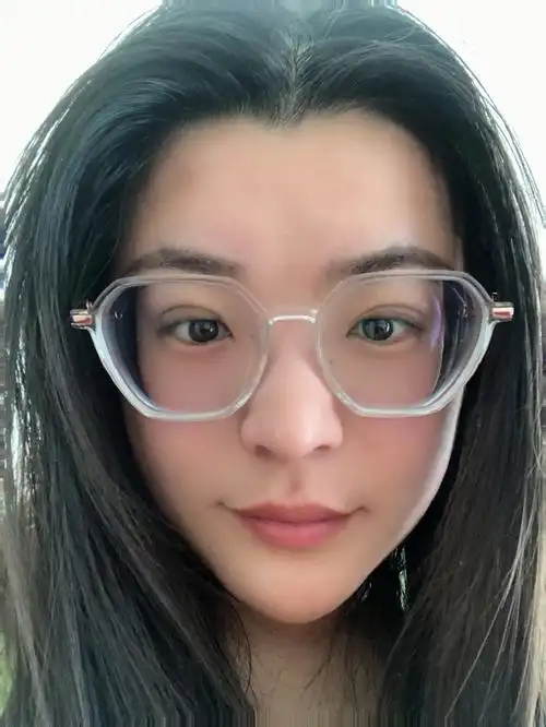 埋线双眼皮第11天