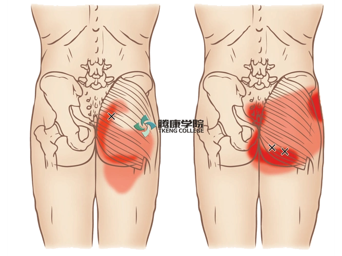 腹股沟疼痛十一块肌肉