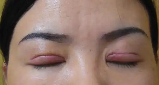 北京双眼皮失败修复要多少钱?