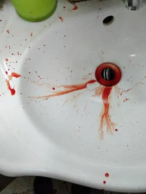 嘴唇针孔状伤口.大量流血.会是白血病吗?