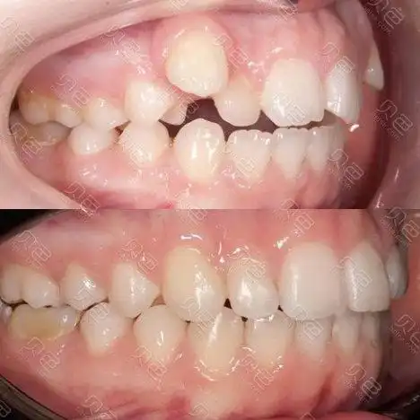 虎牙矫正前后对比
