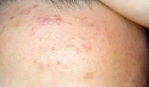 额头上有小痘痘很密集,不疼不痒,可以挤出黑头,会流水,挤得很了会流血