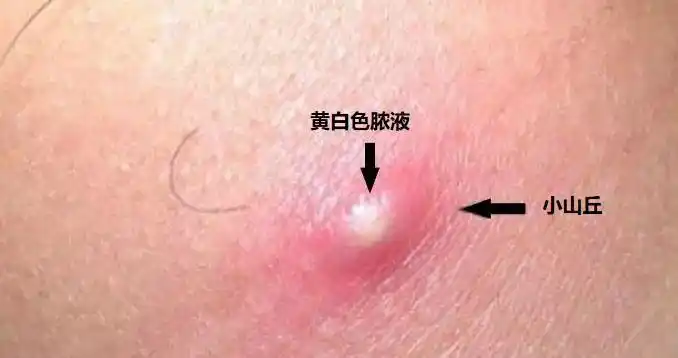 毛囊炎经常出现在发际或胡须处.