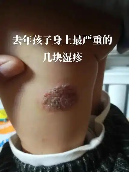 今天忽然在手机里看到孩子以前拍的湿疹照片,现在看着真是很恐怖 - 抖